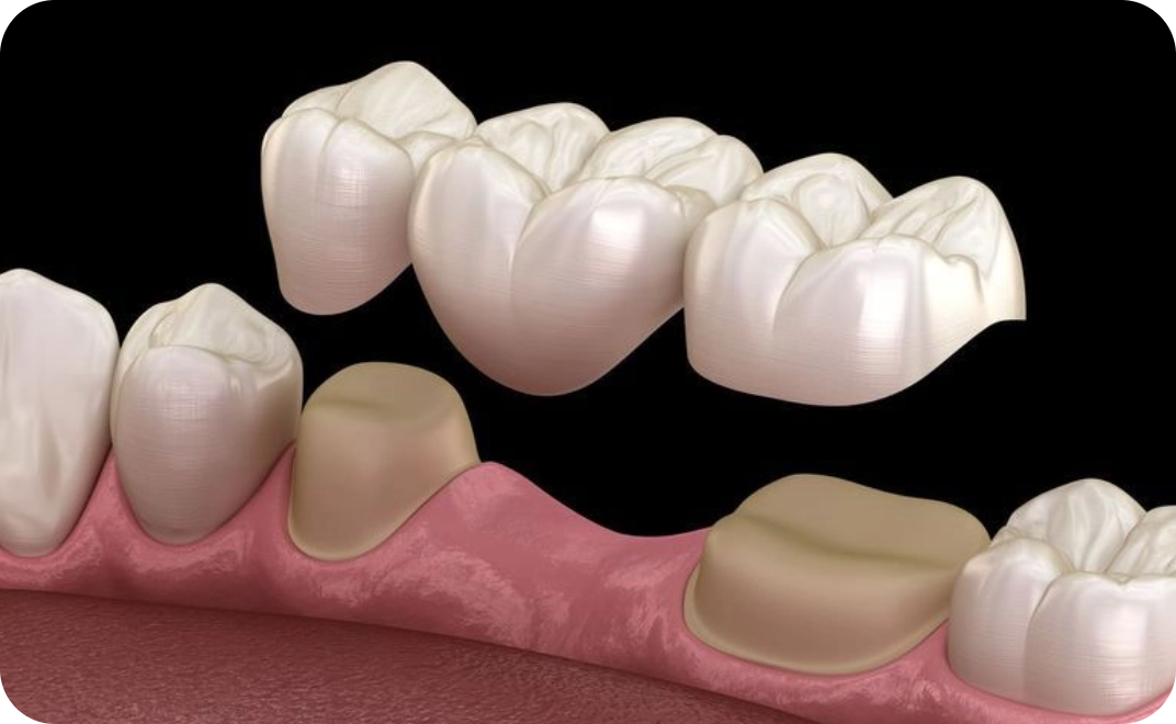 Dental Bridges