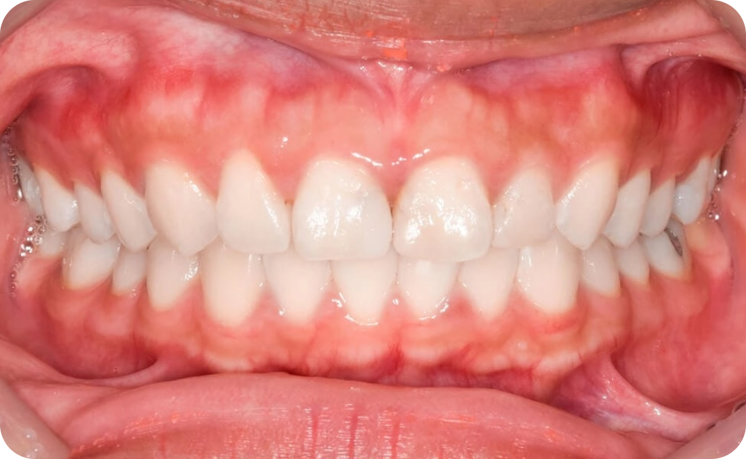 Frenectomy