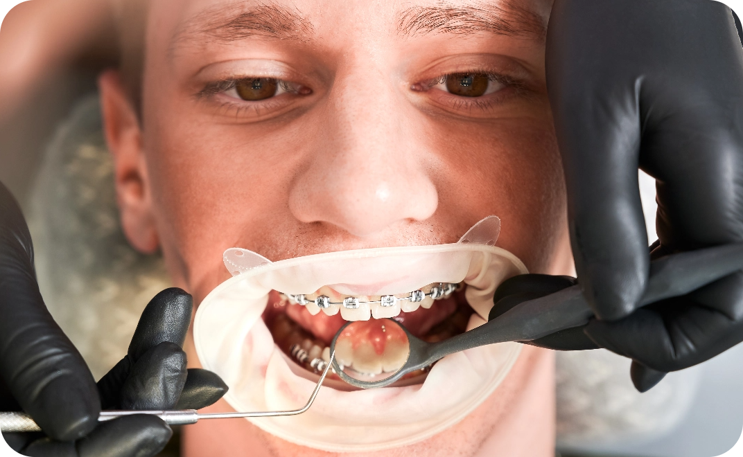 Removables and fixed Retainers