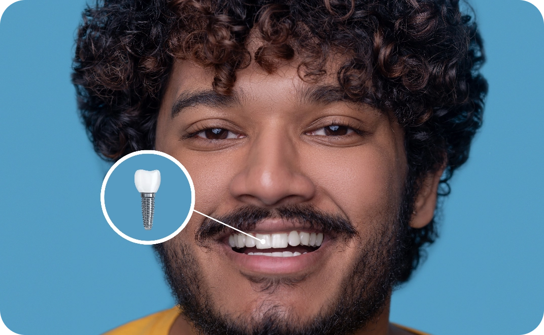 Single-Tooth Implant